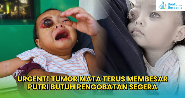 URGENT! Tumor Mata Terus Membesar, Putri Butuh Pengobatan Segera