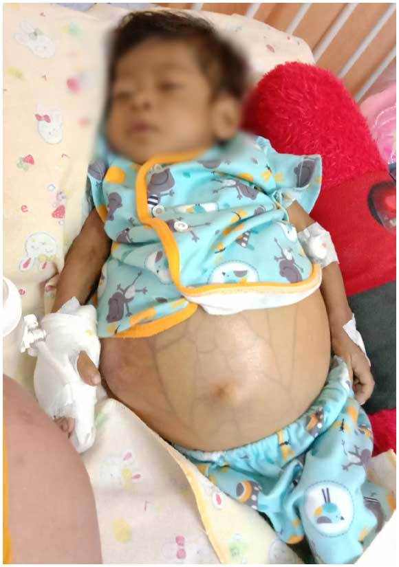 Bantu Ade Yusyfina Cangkok Hati - Bantubersama