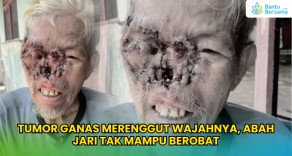 Tumor Ganas Merenggut Wajahnya, Abah Jari Tak Mampu Berobat